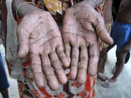 Keratosis as an indication of arsenic poisoning