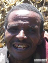 Dental fluorosis