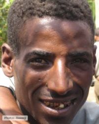 Dental fluorosis