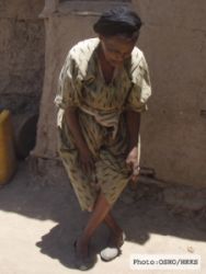 Skeletal fluorosis
