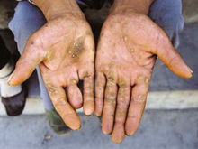 Hyperkeratosis on the palms and fingers and spreading towards the wrist; hyperkeratosis plaques have formed on the thenar of the right hand (This patient lost one and a half fingers in an accident and not due to arsenicosis)