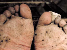 Arsenicosis at feet; Advanced case of hyperkeratosis on the sole and toes resembles fish scales (© China Medical University, Shenyang)  