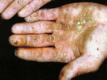 Arsenicosis at hand; coalescing plaques on the palm, especially on the thenar; fingers are seriously affected (© China Medical University, Shenyang)