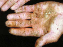 Arsenicosis at hand; coalescing plaques on the palm, especially on the thenar; fingers are seriously affected (© China Medical University, Shenyang) 